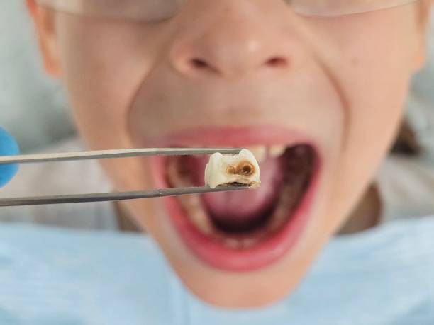 Best Dental Abscess Treatment in Peachtree Corners, GA